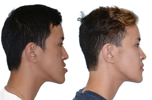 Photographs of the patient orthognathic surgery profile view Before and After with no smile