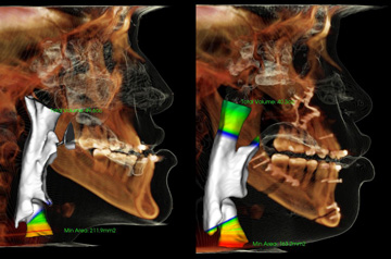 Orthognathic surgery CT-Scan results