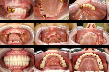 Surgical steps of implant case All-on-4 and Teeth-in-a-Day™