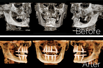 Panoramic "Before" and "After" 3D imaging of All-on-4 and Teeth-in-a-Day™ Surgical Case