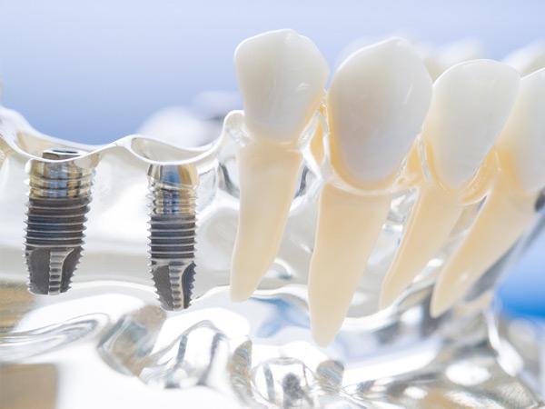 Say Goodbye to Dentures: Discover the Cutting-Edge Dental Implants of 2024