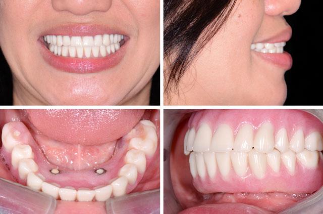 Immediate Implants on Mandible and Teeth All-On-4