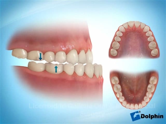 Class III Skeletal Correction