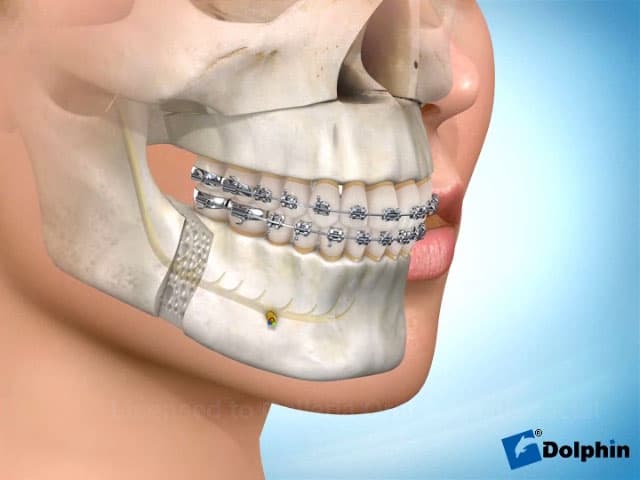 Corrective Jaw Surgery