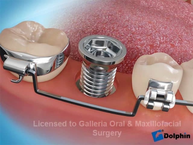 Molar Uprighting for Implant
