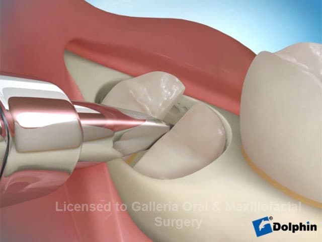 Partial Boney Impaction