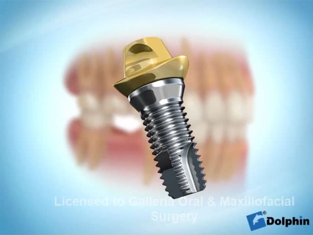 Single Posterior Tooth Replacement
