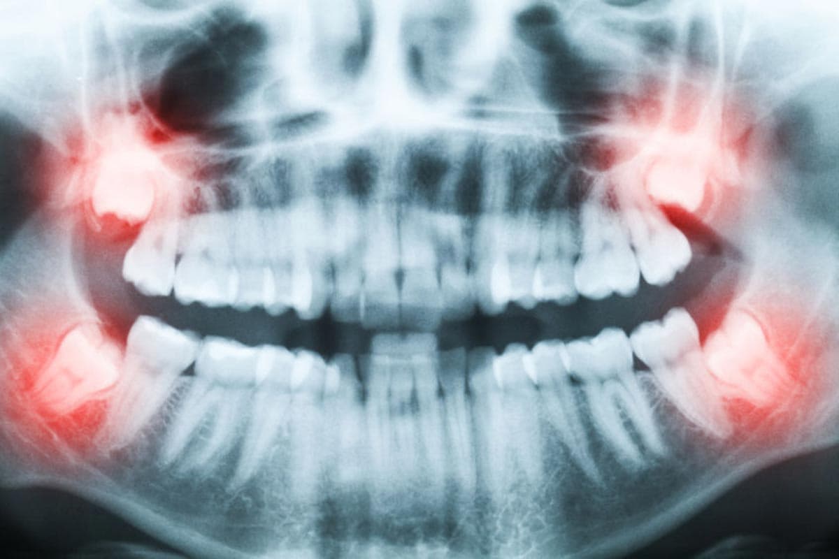 Wisdom Teeth: What You Should Know
