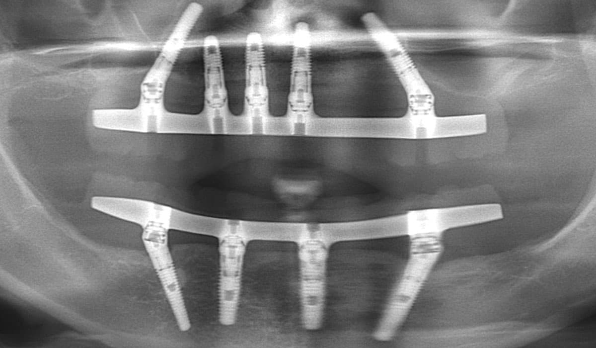 All-on-Four Dental Implants