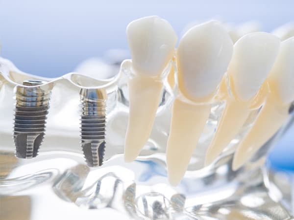 Say Goodbye to Dentures: Discover the Cutting-Edge Dental Implants of 2026