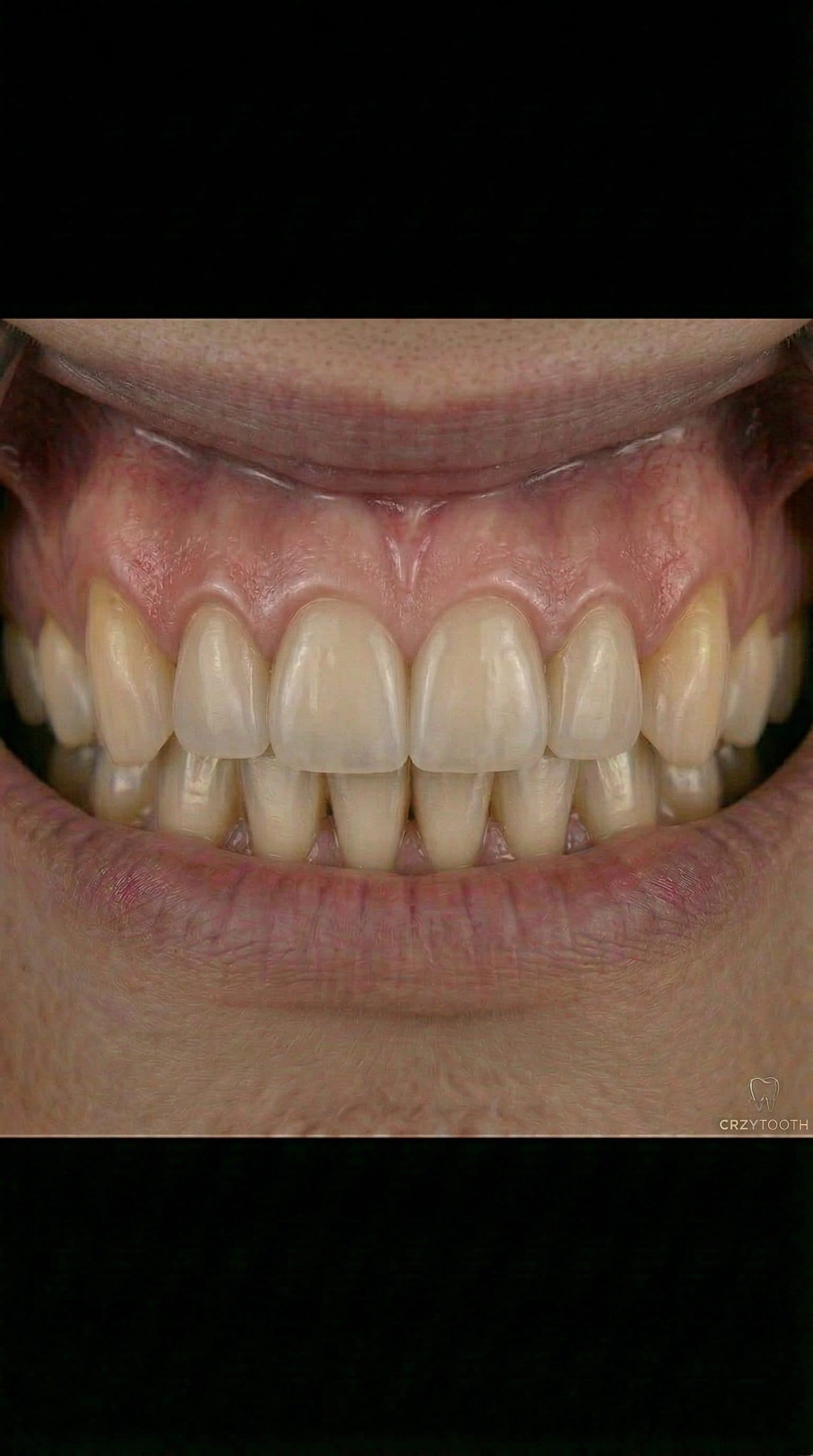 Same-Day Dental Implants (Immediate Load) — Myth or Reality?