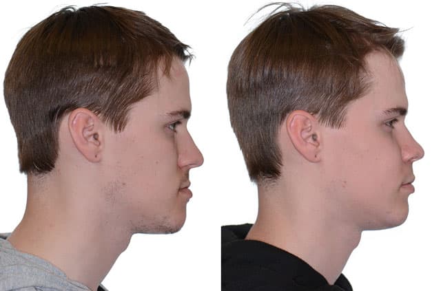 Orthognathic Surgery With Bone Grafting — corrective jaw surgery case by Dr. Antipov in Roseville, CA