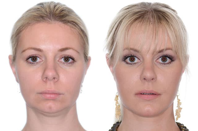 Corrective Jaw Surgery Complete Face Makeover — corrective jaw surgery case by Dr. Antipov in Roseville, CA