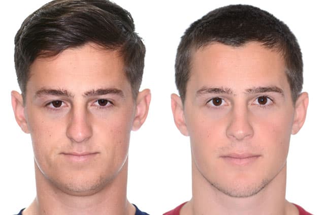 Maxillomandibular Advancement with Genioplasty — before and after corrective jaw surgery result by Dr. Alexander V. Antipov in Roseville, CA