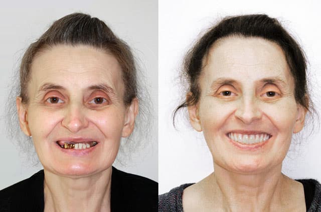 All-on-4 and Teeth-in-a-Day Technique