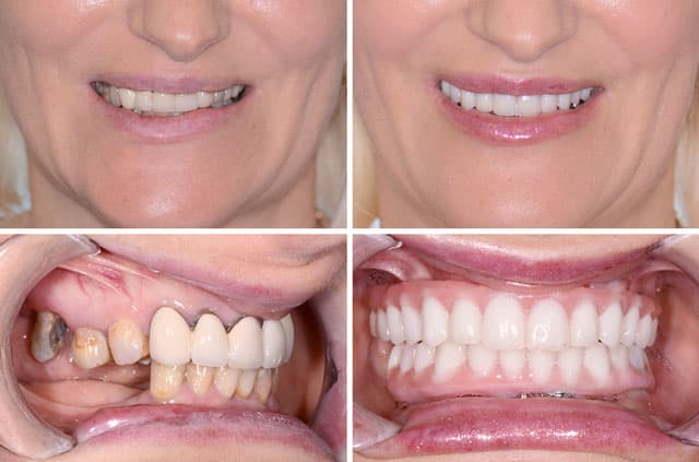 Immediate Implants and Teeth All-On-4 Surgical Case