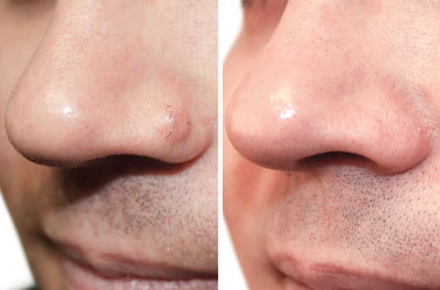 Facial Cosmetic Surgery Case: Scarless Nasal Mole Removal Before & After