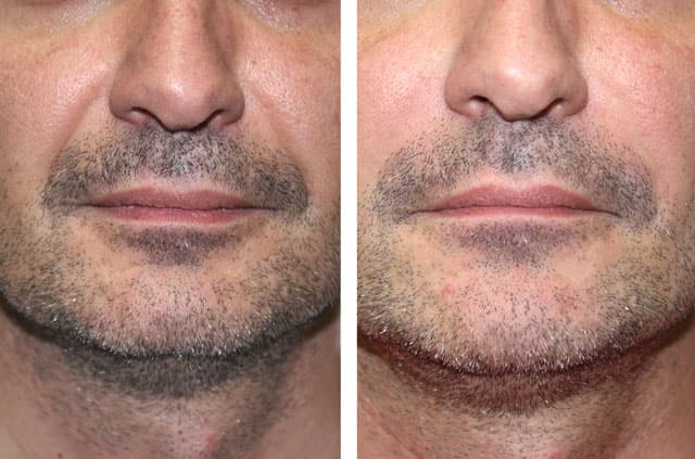 Дермальные филлеры Juvederm — случай по направлению «эстетическая хирургия лица», врач Dr. Antipov, Roseville, CA