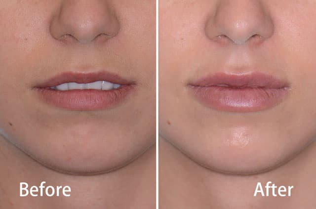 Контурная пластика губ Juvederm — случай по направлению «эстетическая хирургия лица», врач Dr. Antipov, Roseville, CA