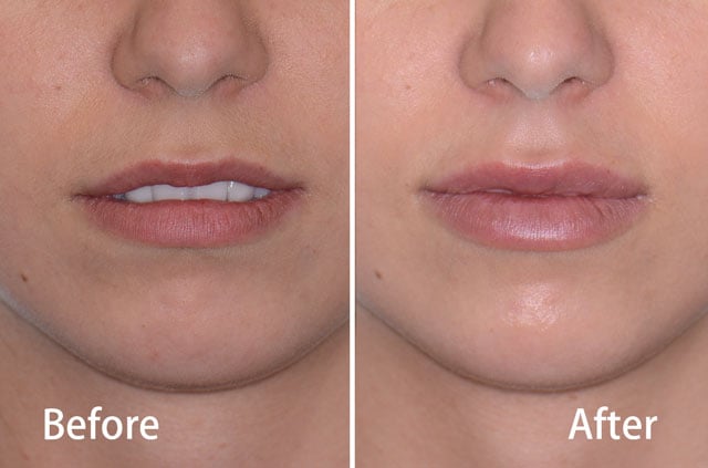 Контурная пластика губ Juvederm — результат «до и после» (эстетическая хирургия лица), врач Dr. Alexander V. Antipov, Roseville, CA