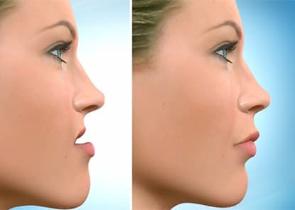 Corrective Jaw Surgery