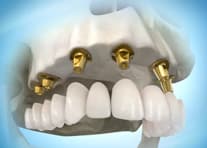 Teeth in an Hour
