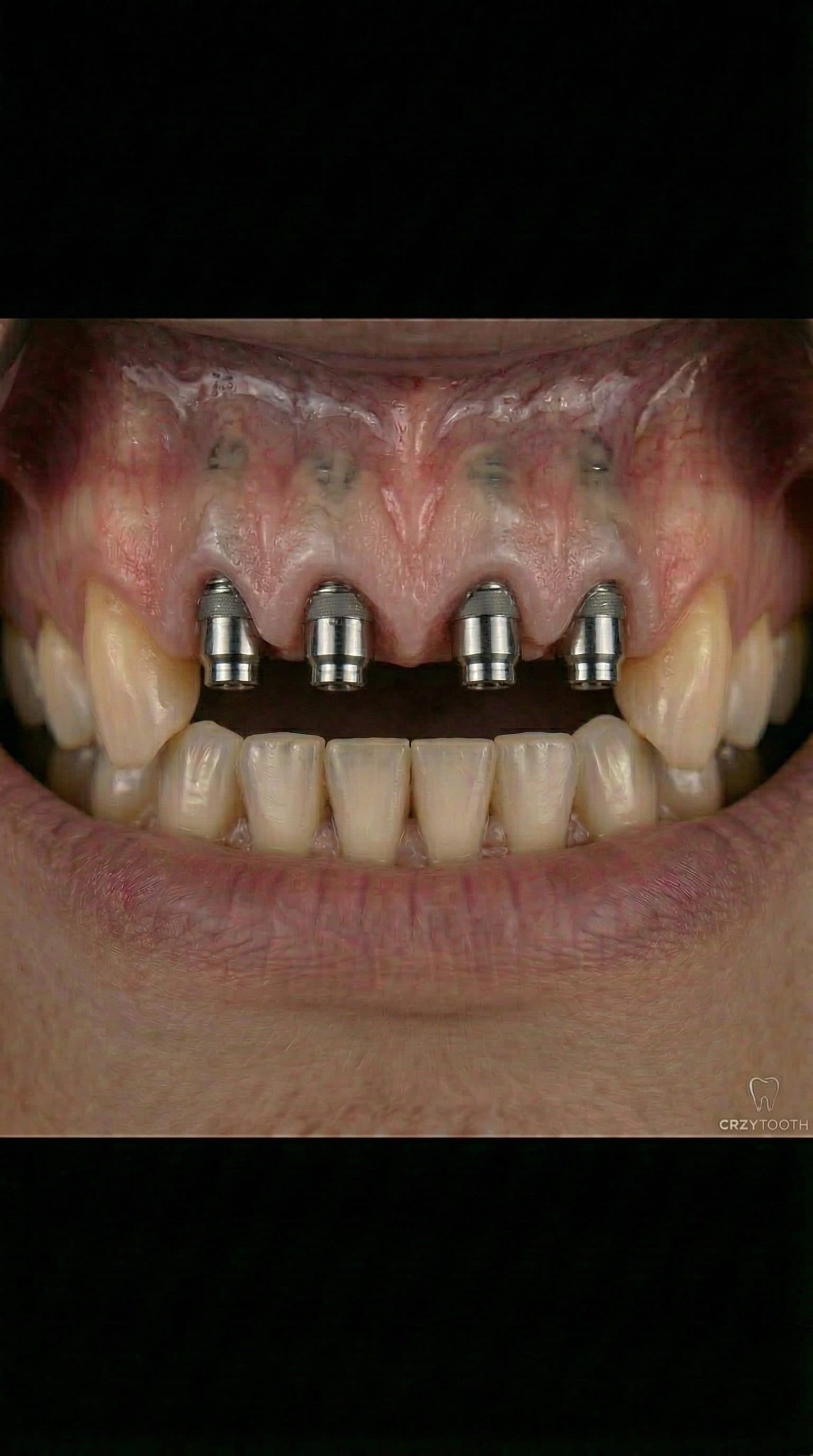 Full-arch implant abutments during treatment