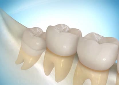 Surgical removal of an impacted wisdom tooth