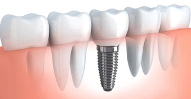 Full Arch Dental Implants — All-on-4, All-on-6, Zygomatic & Teeth-in-a-Day — Dr. Alexander Antipov, Oral Surgeon, Roseville CA