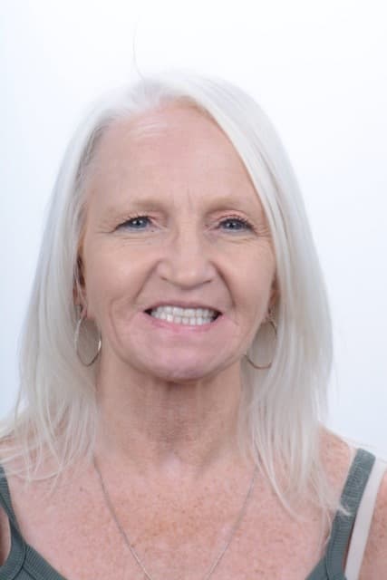 Female patient smiling after dental implant treatment