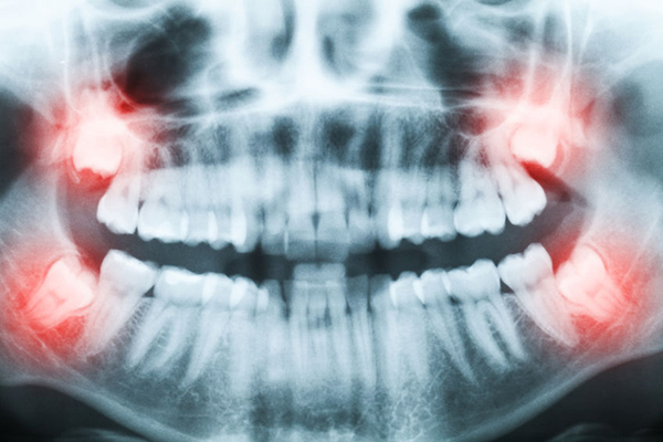 Wisdom teeth removal at Galleria OMS at Roseville, California