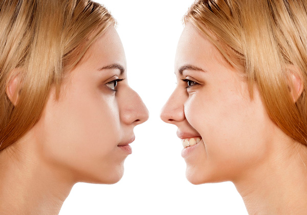 Rhinoplasty performed at Galleria OMS Center by Dr Alexander V. Antipov at Roseville, CA