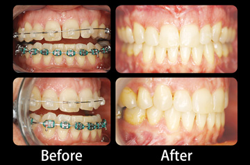 Bite before and after