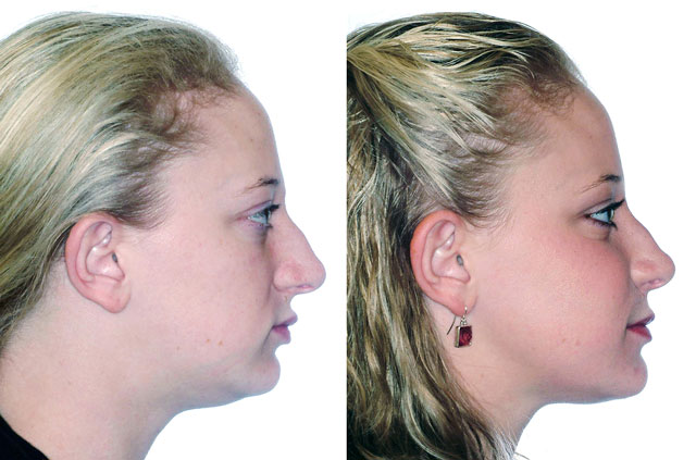 Face, Airway, and Bite Correction surgery profile view