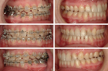 Bite correction surgery results before and after