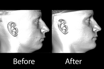 3D Surface Scan before and after