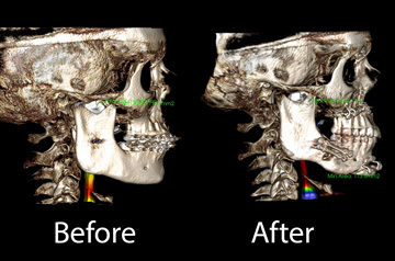 3D Scan Before and after