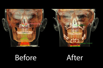3D Scan Frontal View before and after