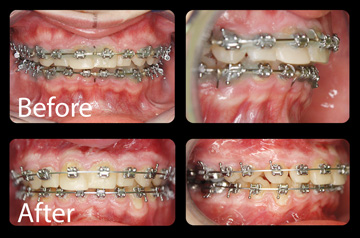 Bite correction before and after