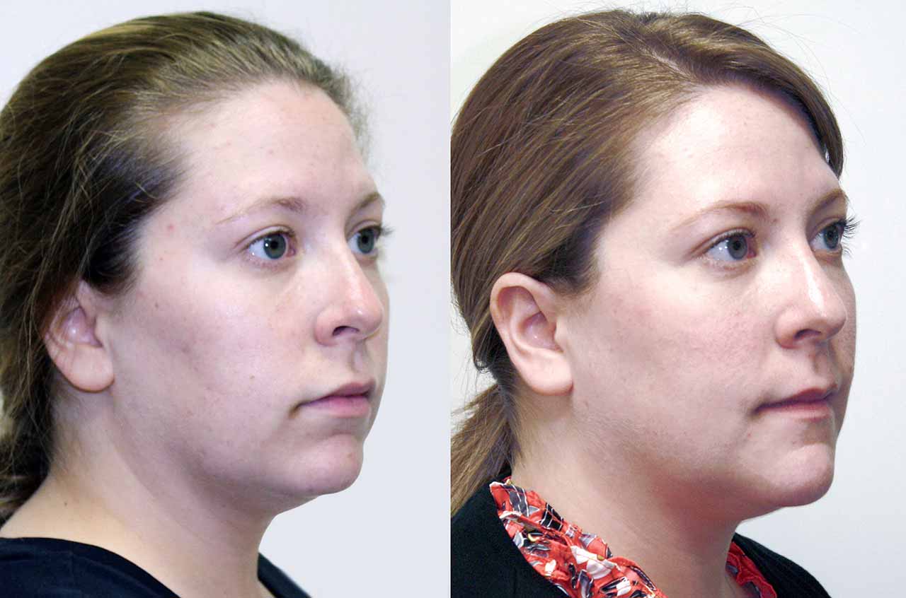 Lower Jaw And Chin Forward Corrective Surgery Dr Antipov.