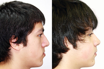 Orthognathic surgery case profile before and after picture