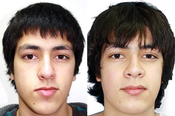 Orthognathic surgery case frontal before and after picture