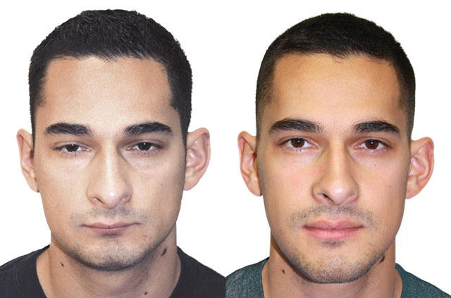 Upper Lower Jaw And Chin Forward Corrective Jaw Surgery Dr Antipov upper-lower-jaw-and-chin-forward-corrective-jaw-surgery-dr-antipov