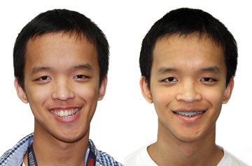 Corrective jaw surgery frontal view with smile