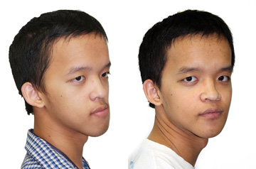 Corrective jaw surgery three quaters view no smile before and after