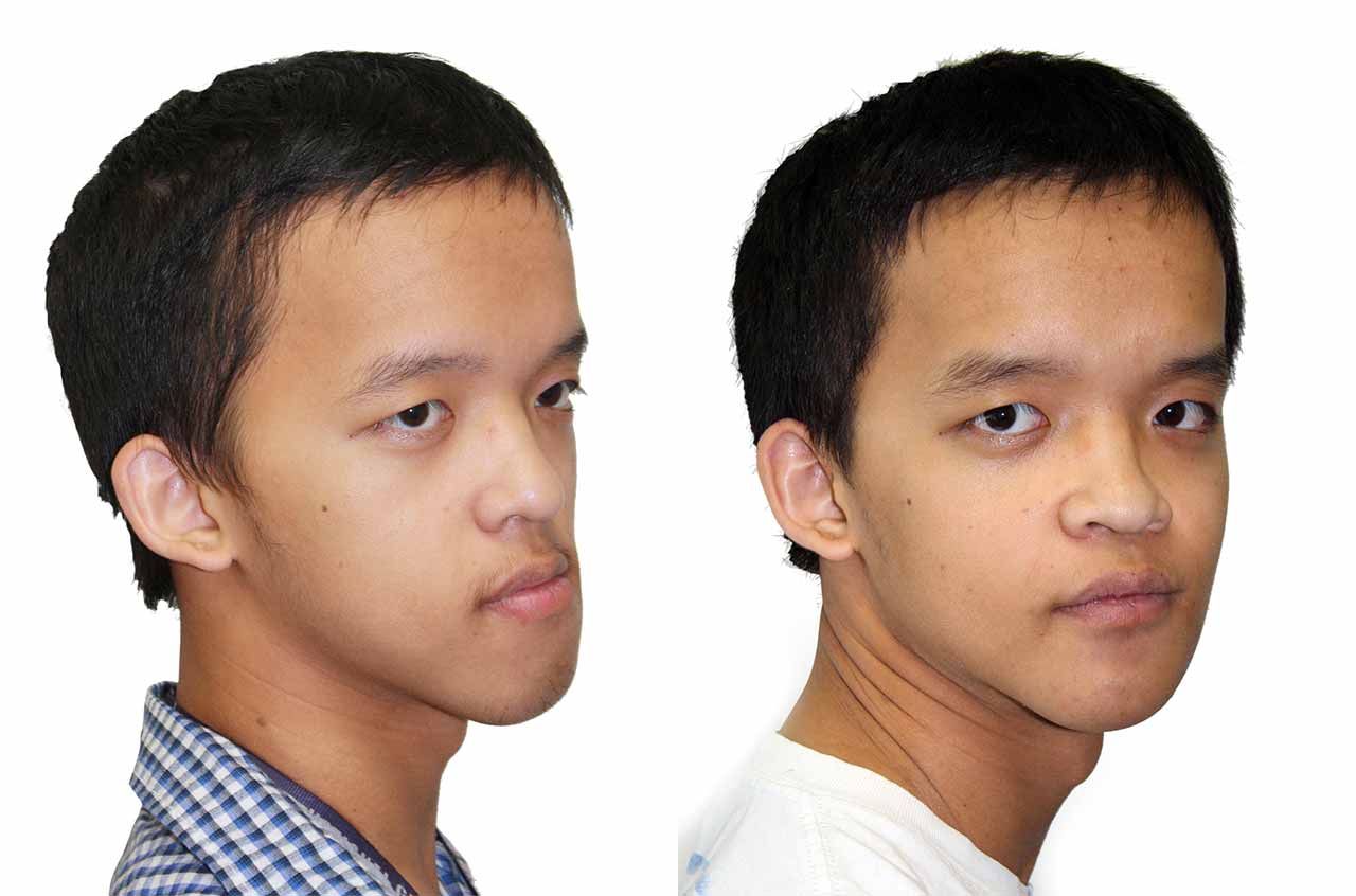 Facial Asymmetry Surgery 90