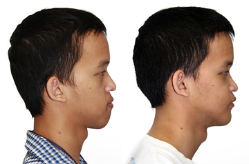 Corrective jaw surgery profile view no smile before and after