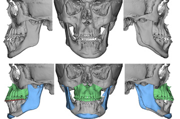 3D surgery planning of corrective jaw surgery