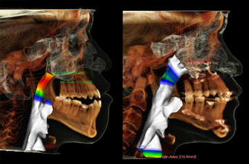 CT-Scan and bite before and after orthognathic surgery