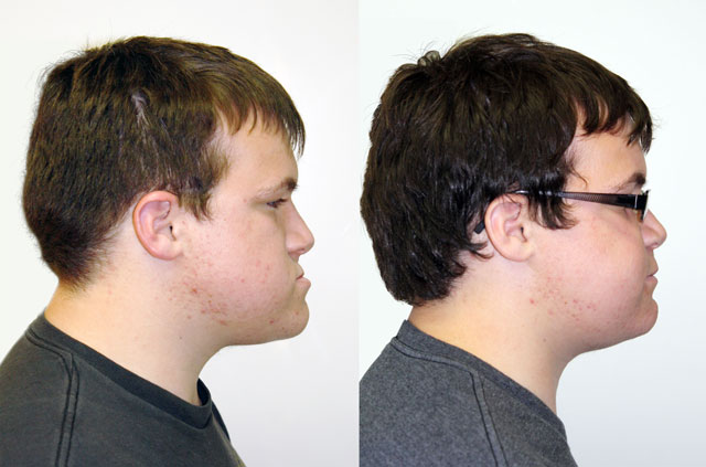 Clockwise Face Rotation and Chin Recontouring profile view